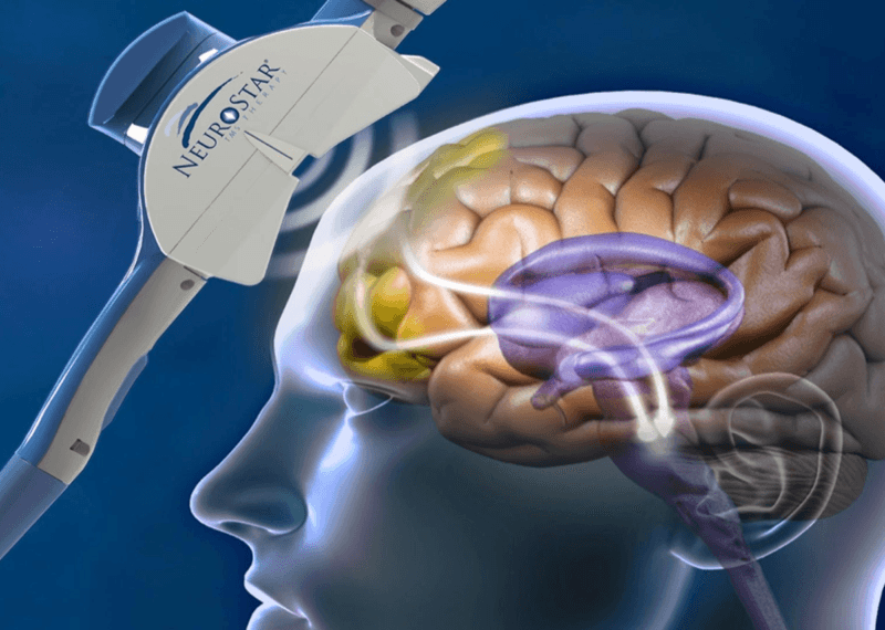 How TMS is Transforming OCD Treatment